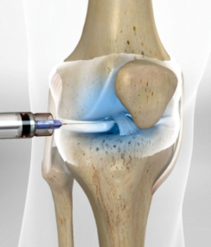 What is Arthritis of the Knee